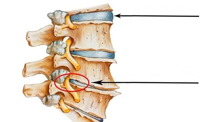 mugurkaula ievainojums dzemdes kakla osteohondrozes gadījumā