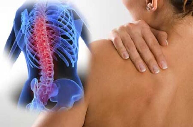 Mugurkaula krūšu kurvja osteohondrozes saasināšanās laikā rodas muguras sāpes