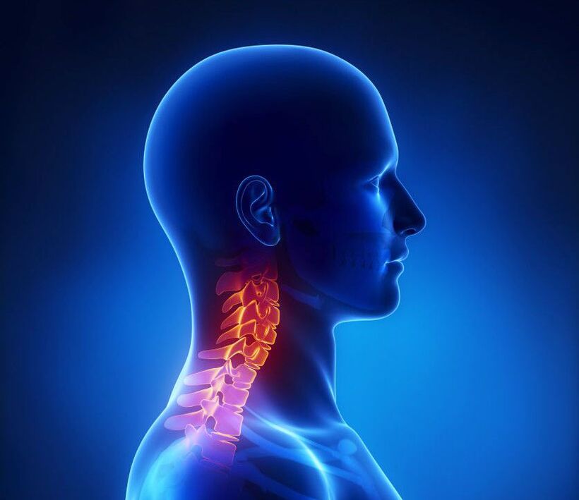 Dzemdes kakla osteohondroze ir mugurkaula patoloģija, no kuras jūs varat atbrīvoties mājās
