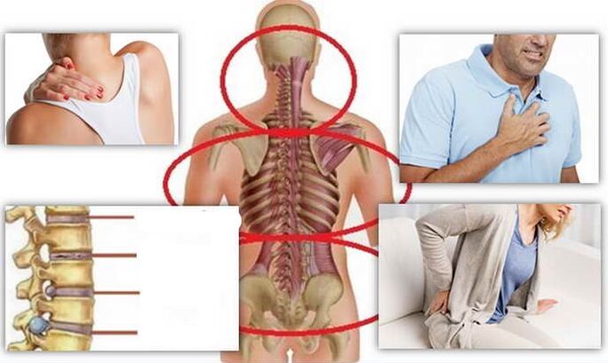 Osteohondrozes slimības vietas