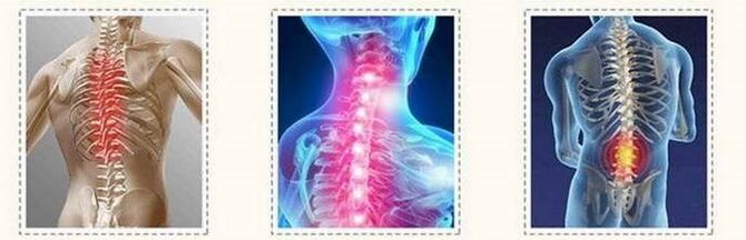 osteohondrozes mugurkaula bojājumi