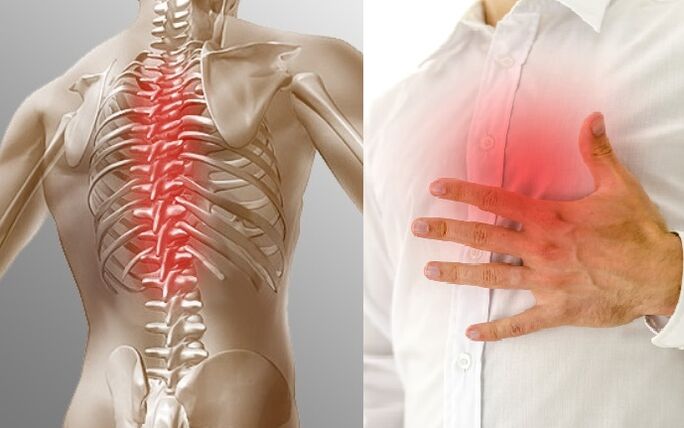 Krūškurvja osteohondroze izpaužas kā sāpes un sasprindzinājuma sajūta krūtīs